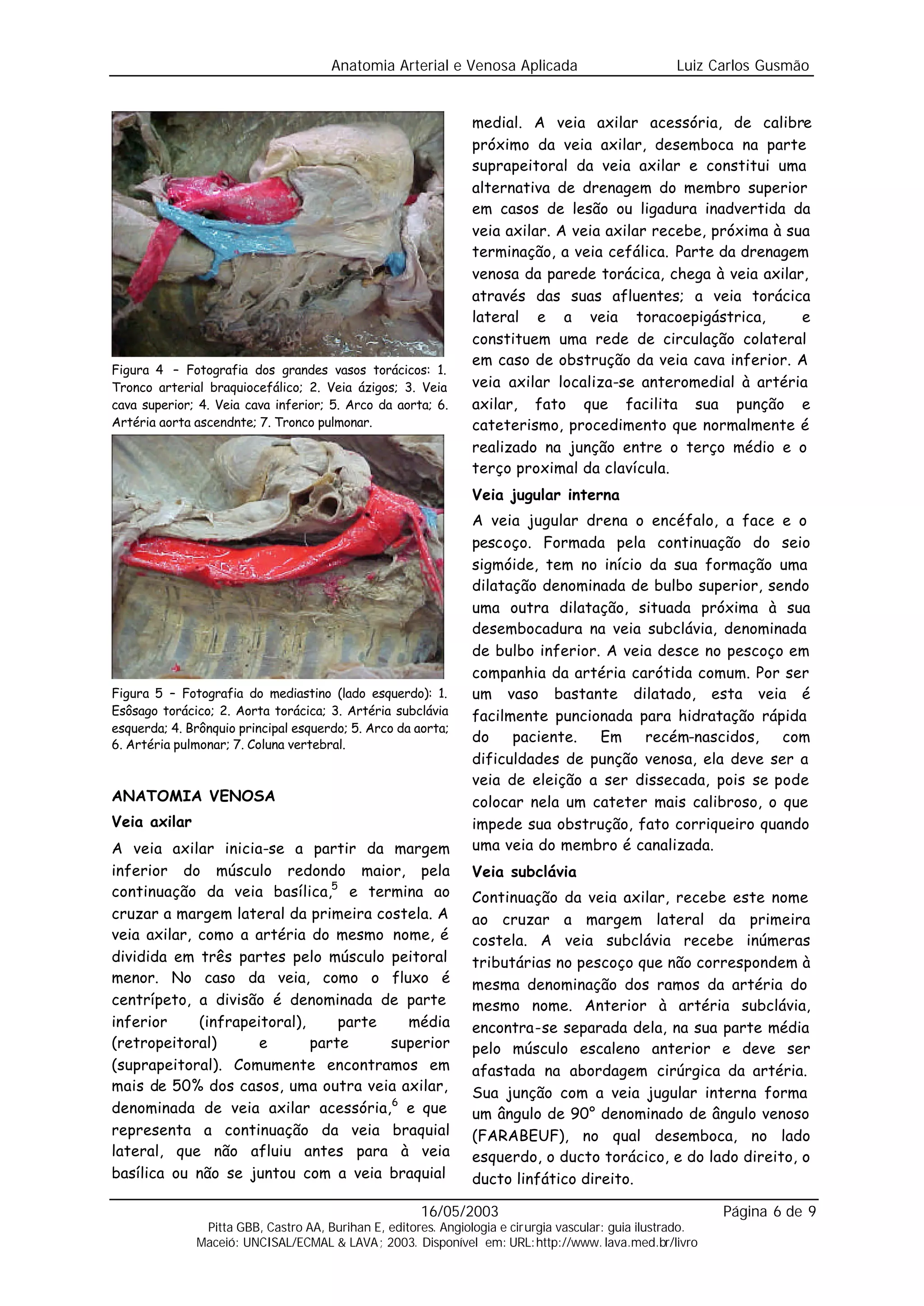 Anatomia Arterial e Venosa Aplicada                            Luiz Carlos Gusmão


                                                                medial. A veia axilar acessória, de calibre
                                                                próximo da veia axilar, desemboca na parte
                                                                suprapeitoral da veia axilar e constitui uma
                                                                alternativa de drenagem do membro superior
                                                                em casos de lesão ou ligadura inadvertida da
                                                                veia axilar. A veia axilar recebe, próxima à sua
                                                                terminação, a veia cefálica. Parte da drenagem
                                                                venosa da parede torácica, chega à veia axilar,
                                                                através das suas afluentes; a veia torácica
                                                                lateral e a veia toracoepigástrica,            e
                                                                constituem uma rede de circulação colateral
                                                                em caso de obstrução da veia cava inferior. A
Figura 4 – Fotografia dos grandes vasos torácicos: 1.
Tronco arterial braquiocefálico; 2. Veia ázigos; 3. Veia        veia axilar localiza-se anteromedial à artéria
cava superior; 4. Veia cava inferior; 5. Arco da aorta; 6.      axilar, fato que facilita sua punção e
Artéria aorta ascendnte; 7. Tronco pulmonar.                    cateterismo, procedimento que normalmente é
                                                                realizado na junção entre o terço médio e o
                                                                terço proximal da clavícula.
                                                                Veia jugular interna
                                                                A veia jugular drena o encéfalo, a face e o
                                                                pescoço. Formada pela continuação do seio
                                                                sigmóide, tem no início da sua formação uma
                                                                dilatação denominada de bulbo superior, sendo
                                                                uma outra dilatação, situada próxima à sua
                                                                desembocadura na veia subclávia, denominada
                                                                de bulbo inferior. A veia desce no pescoço em
                                                                companhia da artéria carótida comum. Por ser
Figura 5 – Fotografia do mediastino (lado esquerdo): 1.         um vaso bastante dilatado, esta veia é
Esôsago torácico; 2. Aorta torácica; 3. Artéria subclávia       facilmente puncionada para hidratação rápida
esquerda; 4. Brônquio principal esquerdo; 5. Arco da aorta;
6. Artéria pulmonar; 7. Coluna vertebral.
                                                                do    paciente.   Em    recém-nascidos,   com
                                                                dificuldades de punção venosa, ela deve ser a
                                                                veia de eleição a ser dissecada, pois se pode
ANATOMIA VENOSA                                                 colocar nela um cateter mais calibroso, o que
Veia axilar                                                     impede sua obstrução, fato corriqueiro quando
A veia axilar inicia-se a partir da margem                      uma veia do membro é canalizada.
inferior do músculo redondo maior, pela                         Veia subclávia
continuação da veia basílica,5 e termina ao                     Continuação da veia axilar, recebe este nome
cruzar a margem lateral da primeira costela. A                  ao cruzar a margem lateral da primeira
veia axilar, como a artéria do mesmo nome, é                    costela. A veia subclávia recebe inúmeras
dividida em três partes pelo músculo peitoral                   tributárias no pescoço que não correspondem à
menor. No caso da veia, como o fluxo é                          mesma denominação dos ramos da artéria do
centrípeto, a divisão é denominada de parte                     mesmo nome. Anterior à artéria subclávia,
inferior     (infrapeitoral),     parte   média                 encontra-se separada dela, na sua parte média
(retropeitoral)       e       parte     superior                pelo músculo escaleno anterior e deve ser
(suprapeitoral). Comumente encontramos em                       afastada na abordagem cirúrgica da artéria.
mais de 50% dos casos, uma outra veia axilar,                   Sua junção com a veia jugular interna forma
denominada de veia axilar acessória, 6 e que                    um ângulo de 90° denominado de ângulo venoso
representa a continuação da veia braquial                       (FARABEUF), no qual desemboca, no lado
lateral, que não afluiu antes para à veia                       esquerdo, o ducto torácico, e do lado direito, o
basílica ou não se juntou com a veia braquial                   ducto linfático direito.

                                                      16/05/2003                                            Página 6 de 9
               Pitta GBB, Castro AA, Burihan E, editores. Angiologia e cirurgia vascular: guia ilustrado.
              Maceió: UNCISAL/ECMAL & LAVA; 2003. Disponível em: URL:http://www. lava.med.br/livro
 