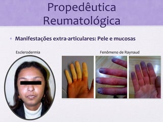 Propedêutica	
  
                             Reumatológica	
  
•  Manifestações	
  extra-­‐articulares:	
  Pele	
  e	
  mucosas	
  

         Esclerodermia	
                        Fenômeno	
  de	
  Raynaud	
  
	
  
       	
  
 