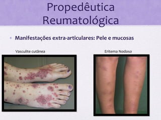 Propedêutica	
  
                             Reumatológica	
  
•  Manifestações	
  extra-­‐articulares:	
  Pele	
  e	
  mucosas	
  

         Vasculite	
  cutânea	
                    Eritema	
  Nodoso	
  
	
  
       	
  
 