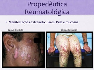 Propedêutica	
  
                               Reumatológica	
  
•  Manifestações	
  extra-­‐articulares:	
  Pele	
  e	
  mucosas	
  

       Lupus	
  Discóide	
                         Livedo	
  Reticular	
  
	
  
       	
  
 