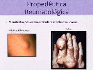 Propedêutica	
  
                           Reumatológica	
  
•  Manifestações	
  extra-­‐articulares:	
  Pele	
  e	
  mucosas	
  

                                                        Tofos	
  
	
       Nódulos	
  Subcutâneos	
  


       	
  
 