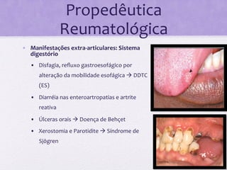 Propedêutica	
  
                        Reumatológica	
  
•  Manifestações	
  extra-­‐articulares:	
  Sistema	
  
   digestório	
  
   •  Disfagia,	
  reﬂuxo	
  gastroesofágico	
  por	
  
          alteração	
  da	
  mobilidade	
  esofágica	
  à	
  DDTC	
  
          (ES)	
  

   •  Diarréia	
  nas	
  enteroartropatias	
  e	
  artrite	
  
          reativa	
  

   •  Úlceras	
  orais	
  à	
  Doença	
  de	
  Behçet	
  
   •  Xerostomia	
  e	
  Parotidite	
  à	
  Síndrome	
  de	
  
          Sjögren	
  
   	
  

   	
  
 