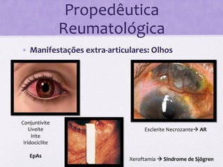 Propedêutica	
  
                    Reumatológica	
  
•  Manifestações	
  extra-­‐articulares:	
  Olhos	
  
    	
  




Conjuntivite	
  
    Uveíte	
                                 Esclerite	
  Necrozanteà	
  AR	
  
     Irite	
  
 Iridociclite	
  
       	
  
     EpAs	
  
                                     Xeroftamia	
  à	
  Sindrome	
  de	
  Sjögren	
  
 