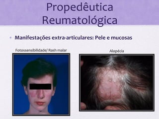 Propedêutica	
  
                             Reumatológica	
  
•  Manifestações	
  extra-­‐articulares:	
  Pele	
  e	
  mucosas	
  

         Fotossensibilidade/	
  Rash	
  malar	
       Alopécia	
  
	
  
       	
  
 