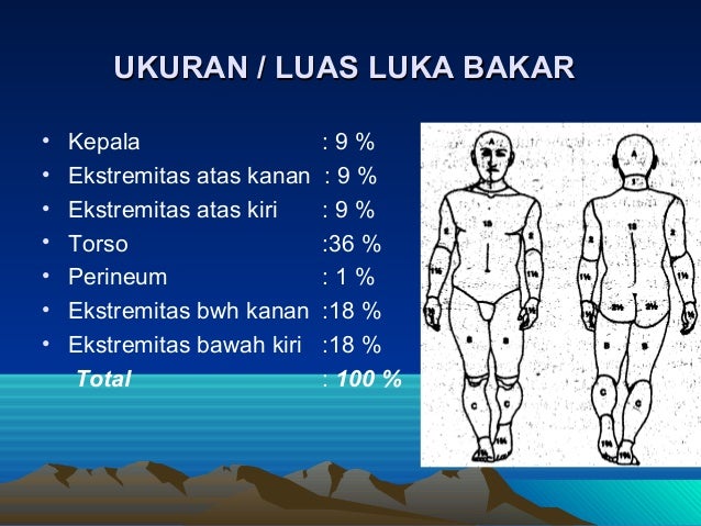 Luka bakar