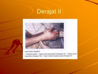Derajat II
 