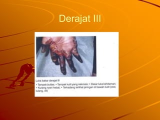 Derajat III
 