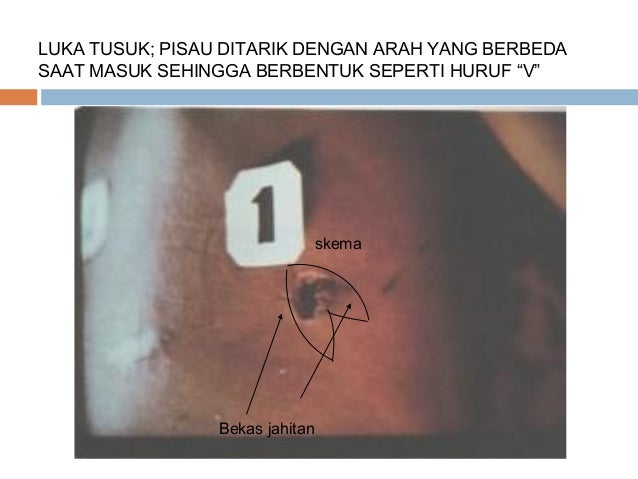 Luka akibat benda tajam & tumpul