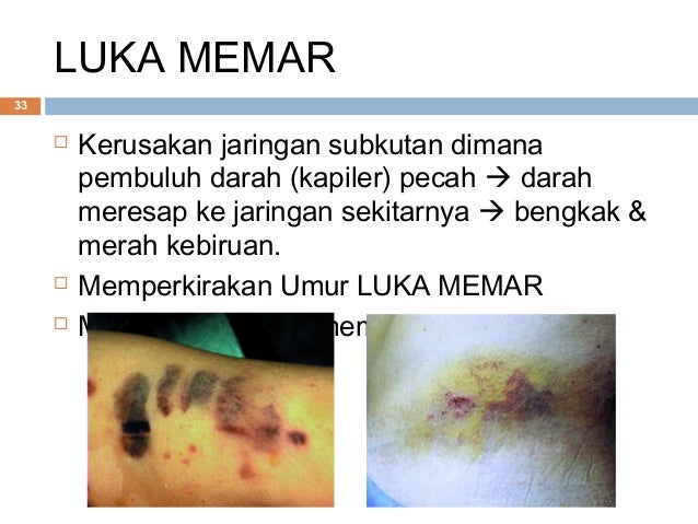 Luka akibat benda tajam & tumpul