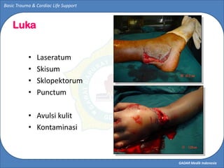 GADAR Medik Indonesia
Basic Trauma & Cardiac Life Support
Luka
• Laseratum
• Skisum
• Sklopektorum
• Punctum
• Avulsi kuli...