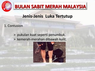 Jenis-Jenis  Luka Tertutup 1. Contusion >  pukulan kuat seperti penumbuk. >  kemerah-merahan dibawah kulit. 