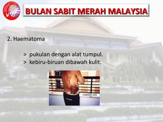 2. Haematoma >  pukulan dengan alat tumpul. >  kebiru-biruan dibawah kulit. 