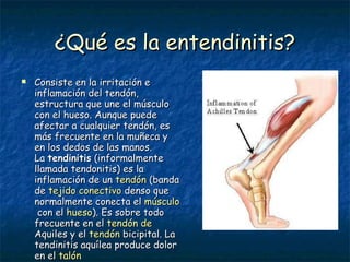 ¿Qué es la entendinitis? Consiste en la irritación e inflamación del tendón, estructura que une el músculo con el hueso. Aunque puede afectar a cualquier tendón, es más frecuente en la muñeca y en los dedos de las manos.  La  tendinitis  (informalmente llamada tendonitis) es la inflamación de un  tendón  (banda de  tejido  conectivo  denso  que normalmente conecta el  músculo  con el  hueso ). Es sobre todo frecuente en el  tendón  de  Aquiles  y el  tendón  bicipital . La tendinitis aquílea produce dolor en el  talón   