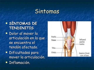 Sintomas SÍNTOMAS DE TENDINITIS Dolor al mover la articulación en la que se encuentra el tendón afectado. Dificultades para mover la articulación. Inflamación. 