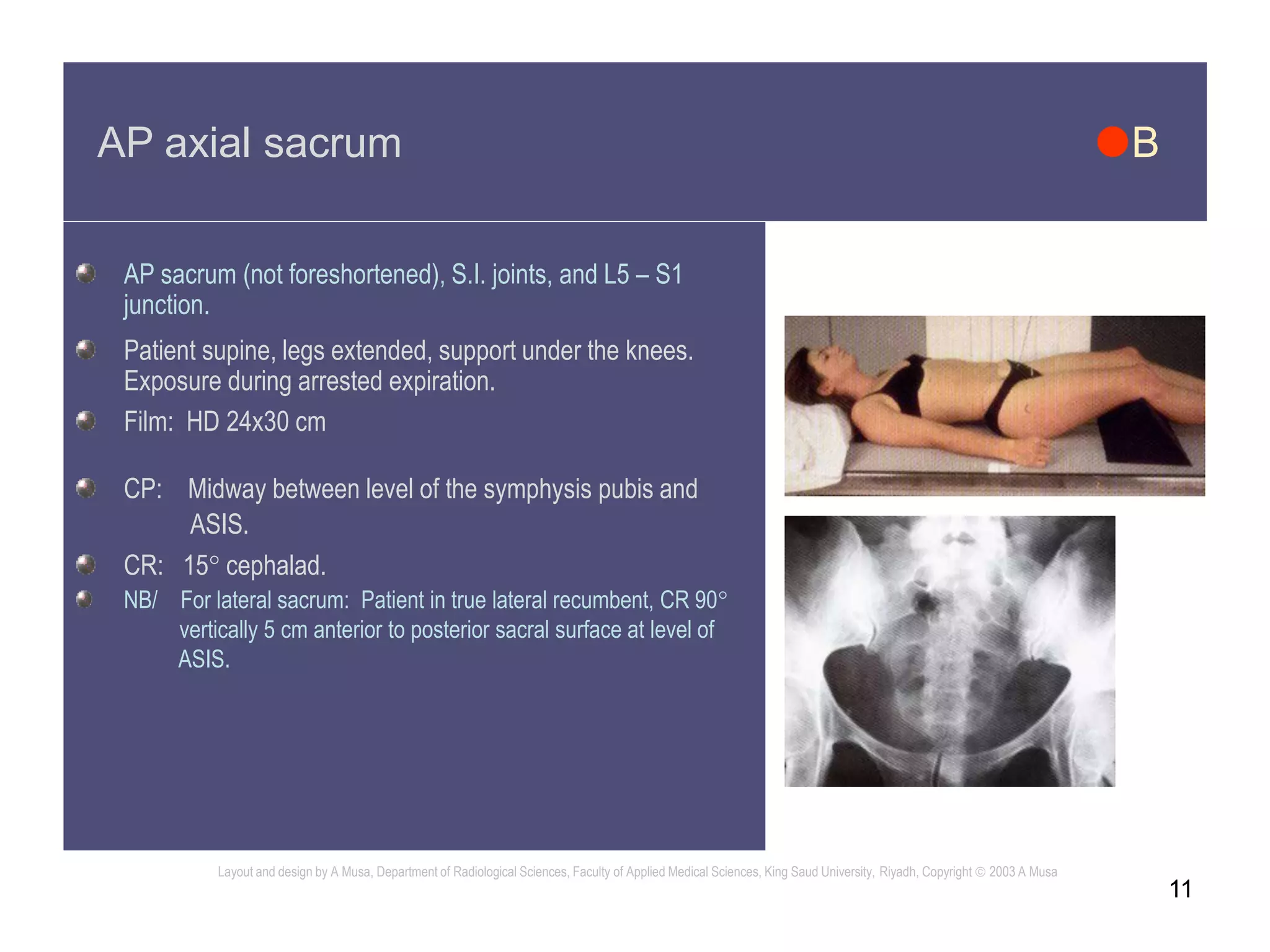 11
AP axial sacrum B
AP sacrum (not foreshortened), S.I. joints, and L5 – S1
junction.
Patient supine, legs extended, support under the knees.
Exposure during arrested expiration.
Film: HD 24x30 cm
CP: Midway between level of the symphysis pubis and
ASIS.
CR: 15 cephalad.
NB/ For lateral sacrum: Patient in true lateral recumbent, CR 90
vertically 5 cm anterior to posterior sacral surface at level of
ASIS.
Layout and design by A Musa, Department of Radiological Sciences, Faculty of Applied Medical Sciences, King Saud University, Riyadh, Copyright  2003 A Musa
 