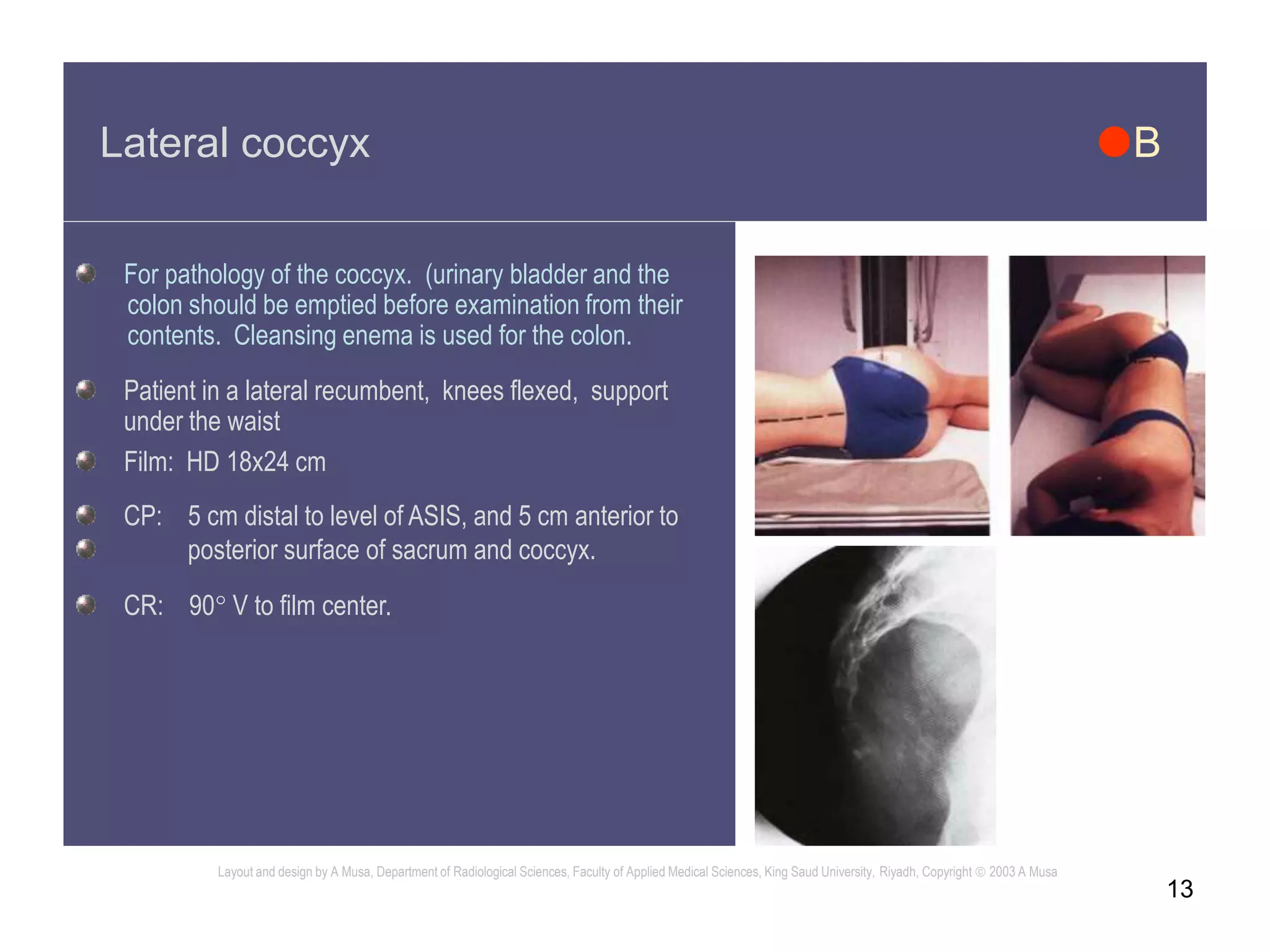 13
Lateral coccyx B
For pathology of the coccyx. (urinary bladder and the
colon should be emptied before examination from their
contents. Cleansing enema is used for the colon.
Patient in a lateral recumbent, knees flexed, support
under the waist
Film: HD 18x24 cm
CP: 5 cm distal to level of ASIS, and 5 cm anterior to
posterior surface of sacrum and coccyx.
CR: 90 V to film center.
Layout and design by A Musa, Department of Radiological Sciences, Faculty of Applied Medical Sciences, King Saud University, Riyadh, Copyright  2003 A Musa
 