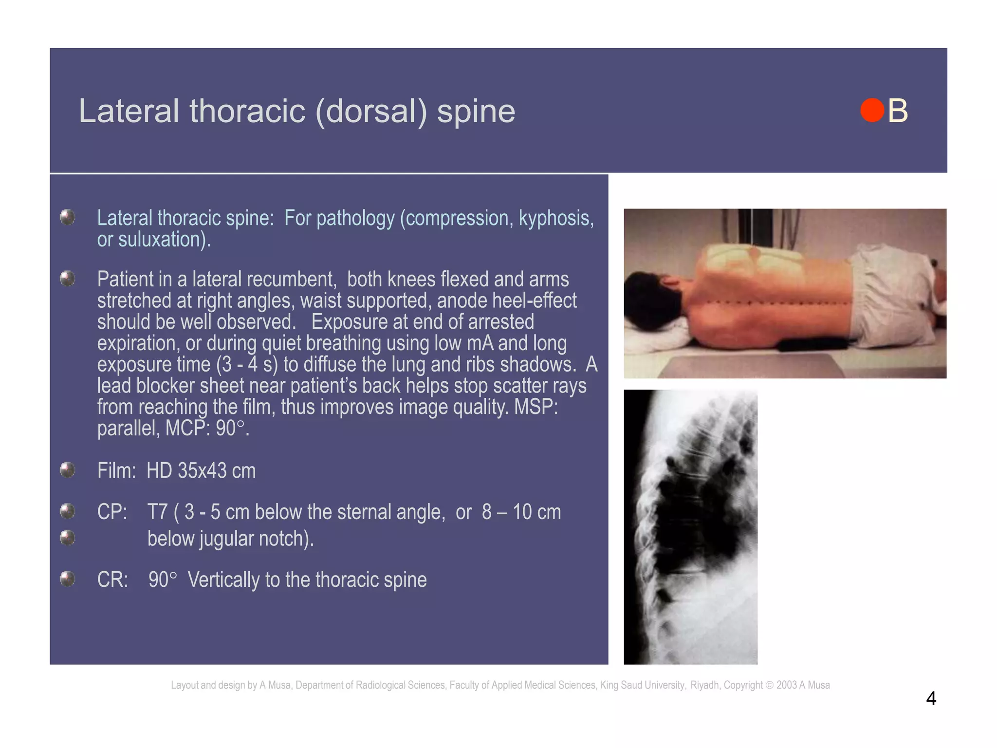 4
Lateral thoracic (dorsal) spine B
Lateral thoracic spine: For pathology (compression, kyphosis,
or suluxation).
Patient in a lateral recumbent, both knees flexed and arms
stretched at right angles, waist supported, anode heel-effect
should be well observed. Exposure at end of arrested
expiration, or during quiet breathing using low mA and long
exposure time (3 - 4 s) to diffuse the lung and ribs shadows. A
lead blocker sheet near patient’s back helps stop scatter rays
from reaching the film, thus improves image quality. MSP:
parallel, MCP: 90.
Film: HD 35x43 cm
CP: T7 ( 3 - 5 cm below the sternal angle, or 8 – 10 cm
below jugular notch).
CR: 90 Vertically to the thoracic spine
Layout and design by A Musa, Department of Radiological Sciences, Faculty of Applied Medical Sciences, King Saud University, Riyadh, Copyright  2003 A Musa
 