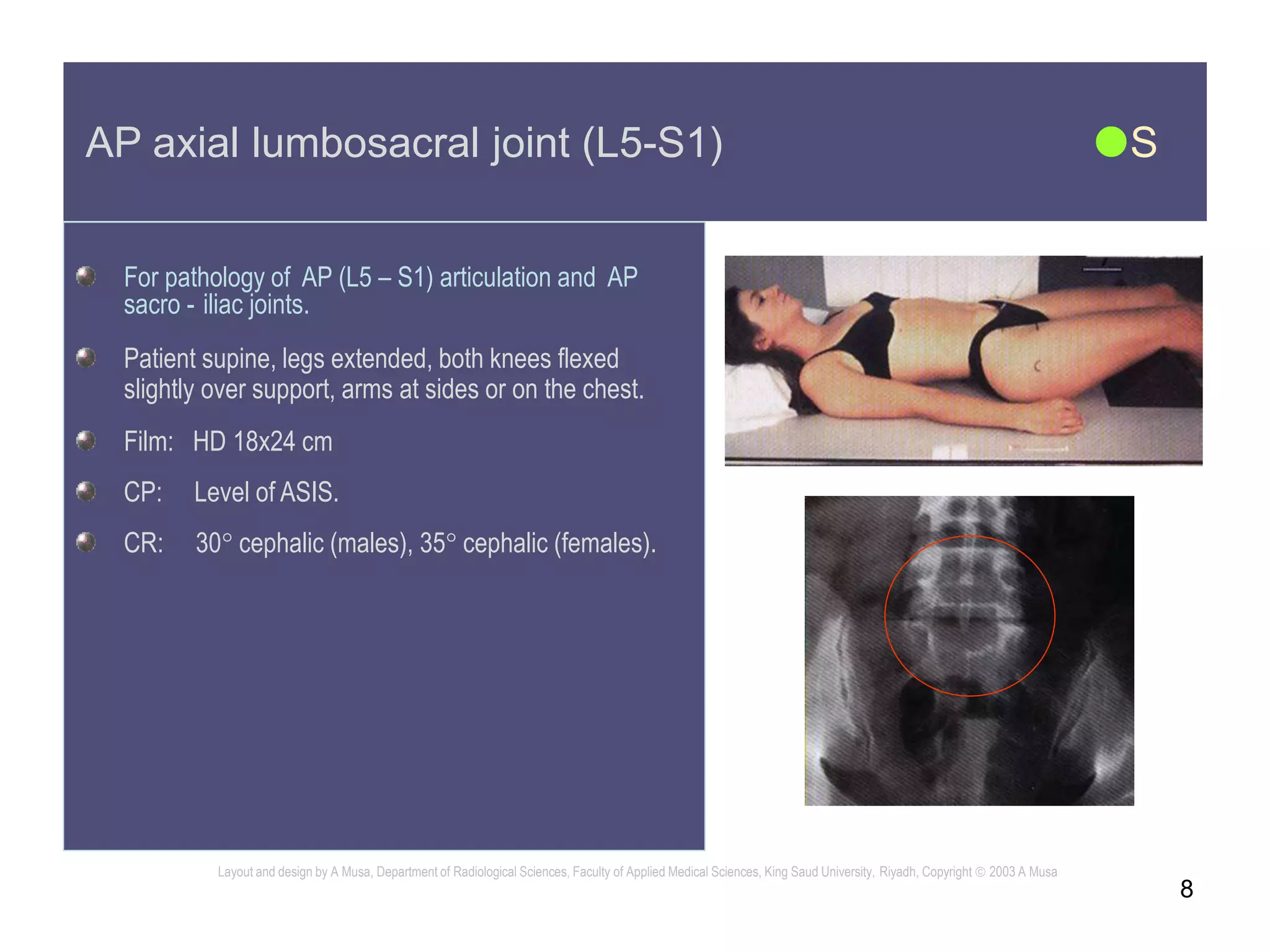 8
AP axial lumbosacral joint (L5-S1) S
For pathology of AP (L5 – S1) articulation and AP
sacro - iliac joints.
Patient supine, legs extended, both knees flexed
slightly over support, arms at sides or on the chest.
Film: HD 18x24 cm
CP: Level of ASIS.
CR: 30 cephalic (males), 35 cephalic (females).
Layout and design by A Musa, Department of Radiological Sciences, Faculty of Applied Medical Sciences, King Saud University, Riyadh, Copyright  2003 A Musa
 