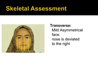 Transverse:
Mild Asymmetrical
face.
nose is deviated
to the right
 