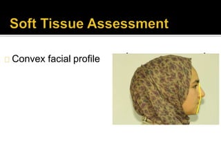 Convex facial profile
 