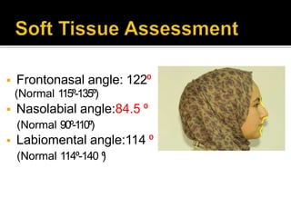  Frontonasal angle: 122⁰
(Normal 115⁰-135⁰)
 Nasolabial angle:84.5 ⁰
(Normal 90⁰-110⁰)
 Labiomental angle:114 ⁰
(Normal 114⁰-140 ⁰)
 