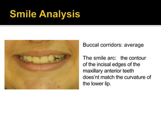 • Buccal corridors: average
• The smile arc: the contour
of the incisal edges of the
maxillary anterior teeth
does’nt match the curvature of
the lower lip.
 
