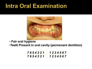 • Fair oral hygiene
•Teeth Present in oral cavity (permenant dentition)
7 6 5 4 3 2 1 1 2 3 4 5 6 7
7 6 5 4 3 2 1 1 2 3 4 5 6 7
 
