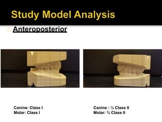 Anteroposterior
Canine: Class I
Molar: Class I
Canine : ½ Class II
Molar: ¾ Class II
 