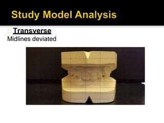 Transverse
Midlines deviated
 
