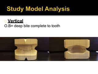 Vertical
O.B= deep bite complete to tooth
 