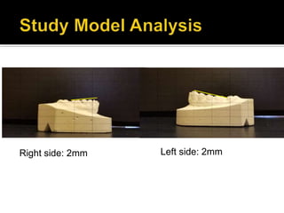Right side: 2mm Left side: 2mm
 