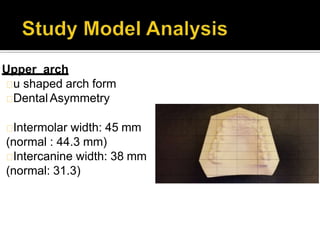 Upper arch
u shaped arch form
Dental Asymmetry
Intermolar width: 45 mm
(normal : 44.3 mm)
Intercanine width: 38 mm
(normal: 31.3)
 