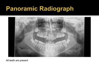 All teeth are present
 