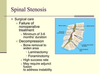 Spinal Stenosis
 Surgical care
      Failure of
       nonoperative
       treatment
           Minimum of 3-6
            months’ duration
      Decompression
           Bone removal to
            widen area
               Laminectomy
               Foraminotomy
           High success rate
           May require adjunct
            fusion
            to address instability
 