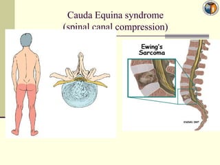 Cauda Equina syndrome
(spinal canal compression)
 