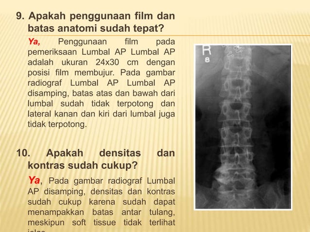 Loopografi Normal Radiologi ppt kritisi dan evaluasi radiograf Lumbal dan Lumbosacral | PPTX