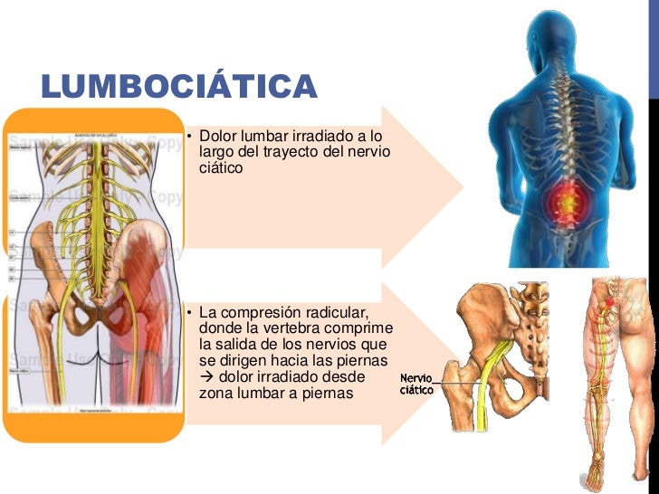 Lumbalgia Lumbalgia