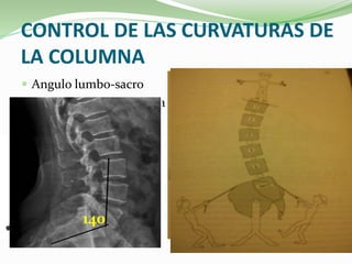Nosología de Lumbalgia | PPTX