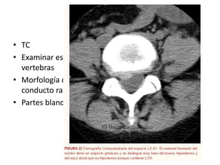 • TC
• Examinar estado de
vertebras
• Morfología del
conducto raquídeo
• Partes blandas
 