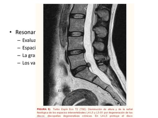 • Resonancia magnética
– Evaluar medula espinal
– Espacios meníngeos
– La grasa epidural
– Los vasos
 