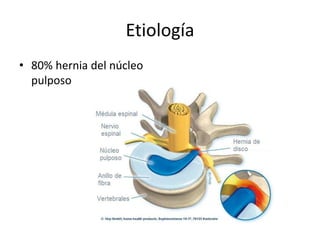 Etiología
• 80% hernia del núcleo
pulposo
 