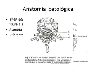 Anatomía patológica
• 2º-3º década de vida se
fisura el anillo
• Acentúa de 30-50 años
• Diferentes rutas
 