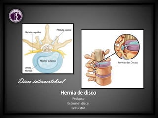 Disco intervertebral
Prolapso
Extrusión discal
Secuestro
 
