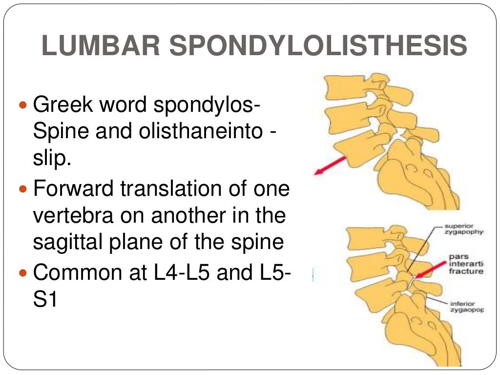 lumbar spondylosis thesis