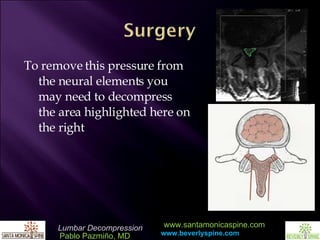 To remove this pressure from the neural elements you may need to decompress the area highlighted here on the right 