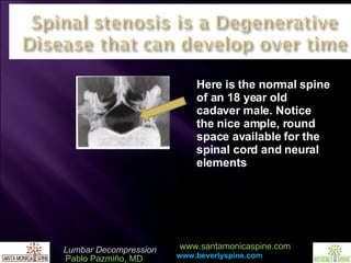 Here is the normal spine of an 18 year old cadaver male. Notice the nice ample, round space available for the spinal cord and neural elements 