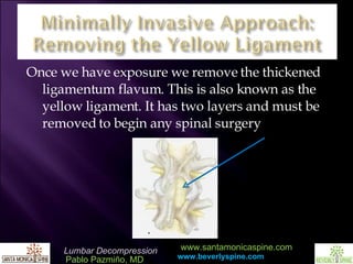 Once we have exposure we remove the thickened ligamentum flavum. This is also known as the yellow ligament. It has two layers and must be removed to begin any spinal surgery 