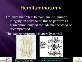 Dr Pazmino prefers to maintain the lamina’s integrity. In order to do this he performs a hemilaminotomy on the side that needs to be decompressed.  This can be performed bilaterally as well 