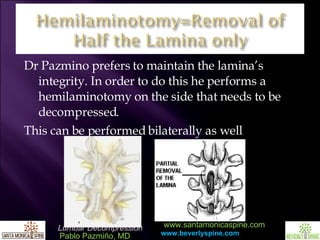 Dr Pazmino prefers to maintain the lamina’s integrity. In order to do this he performs a hemilaminotomy on the side that needs to be decompressed.  This can be performed bilaterally as well 