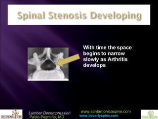 With time the space begins to narrow slowly as Arthritis develops 